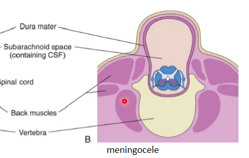 <p><strong><span>&nbsp;(spina bifida cystica)</span></strong></p><ul><li><p><span>Fluctuating (as there's fluid which when touched moves) midline cystic mass covered with skin</span></p></li><li><p><span>Only meninges protrude</span></p></li><li><p><span>Spinal cord is still intact</span></p></li><li><p><span>May be associated with neurological defects</span></p></li><li><p><span>May develop defects like:</span></p><ul><li><p><span>Weakness of legs</span></p></li><li><p><span>Trouble with bowel and bladder control</span></p></li></ul><p>These issues may change or progress as children grow</p></li></ul>