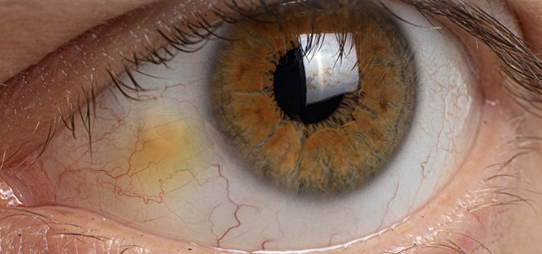 <p>One of the Normal Findings for <strong><em>6. Inspect bulbar conjunctiva and sclera</em></strong></p><ul><li><p>Yellowish nodules on the bulbar conjunctiva</p></li><li><p>Harmless nodules common in older clients</p></li><li><p>Appear first on the medial side of the iris and then on the lateral side</p></li></ul><p></p>