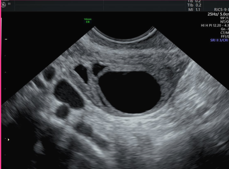 <p>Follicular cysts are ______, ______ and less than _____ but can be as large as _____ in diameter</p>