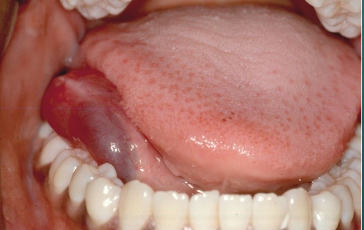 <p>Where is a ranula typically located?</p>