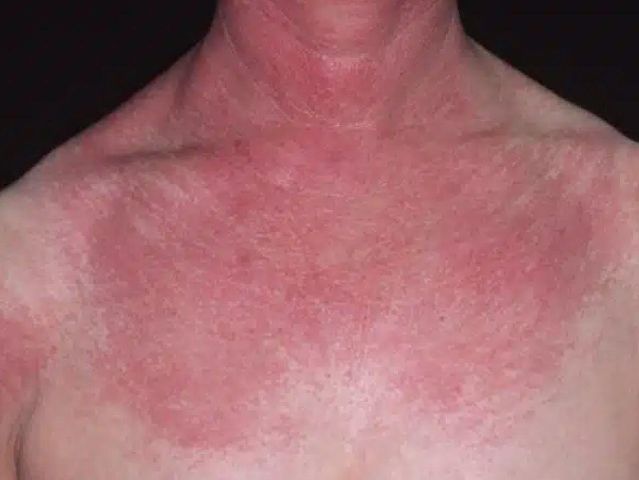 <p>Erythema</p>