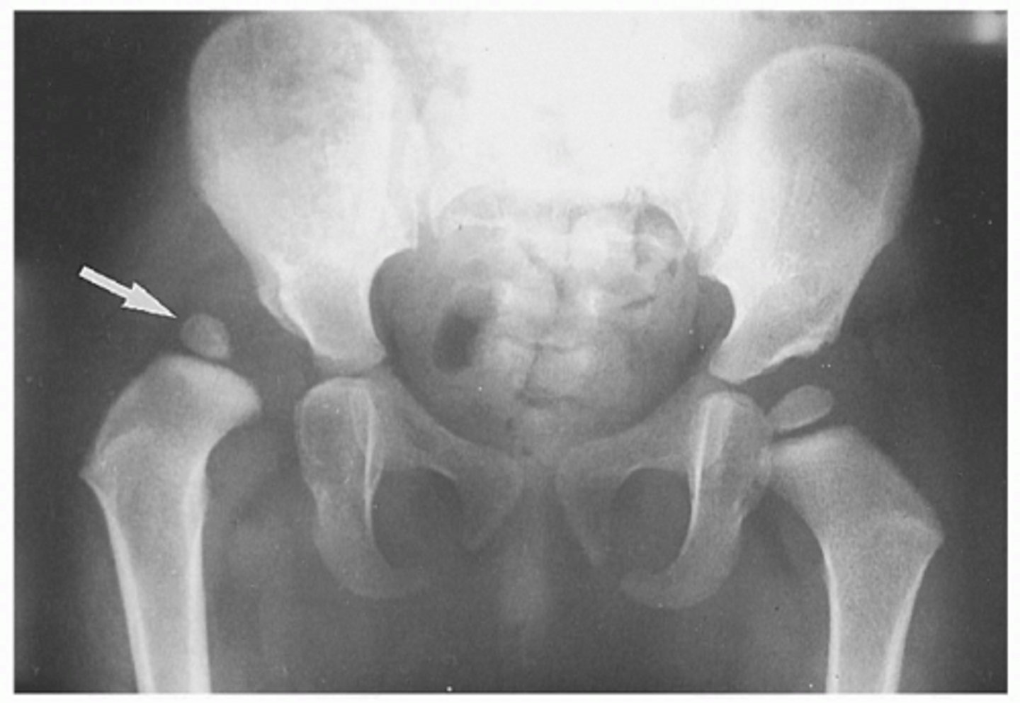 <p>Developmental Dysplasia of the Hip (DDH) is an abnormality in the hip joint, usually present from birth.</p><p>There is an abnormality in either the shape of the head of the femur, the shape of the acetabulum, or supporting structures around them. </p><p>As a result, the acetabulum &amp; femur are not in close contact as they should be.</p>