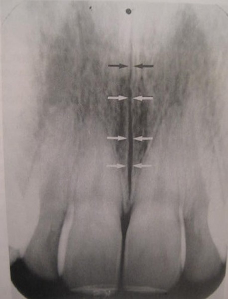 <p>"crack" between roots of maxillary central incisors</p><p>area of incomplete fusion</p><p>radiolucent</p>