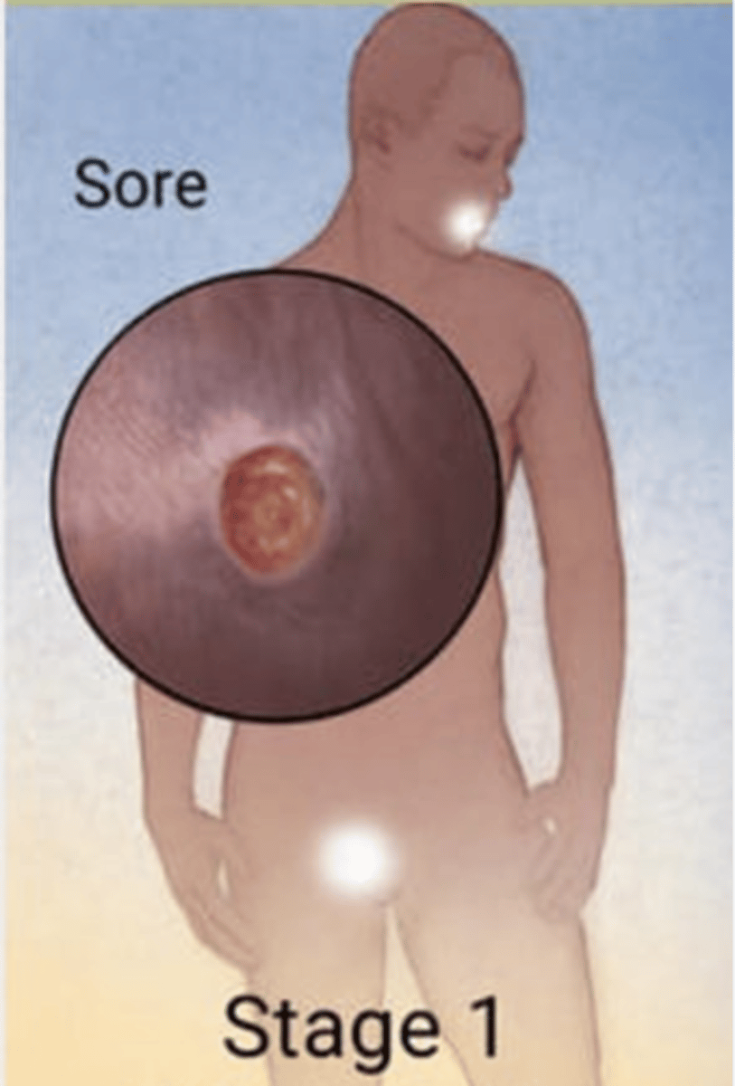 <p>10-90 days after initial infection</p><p>Chancre: firm, painless, papule or ulceration with a raised border</p><p>Regional lymphadenopathy</p>