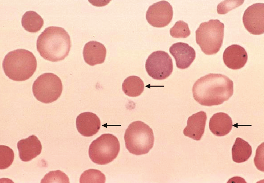 <ul><li><p>abnormally dark and compacted cells</p></li><li><p>MCV is nearly normal, but MCHC is greater than 32%</p></li><li><p>results from hereditary spherocytosis or autoimmune hemolytic anemia</p></li></ul><p></p>