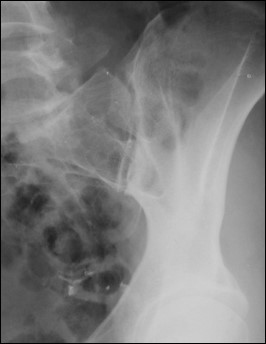 <p>Insufficient obliquity.</p>