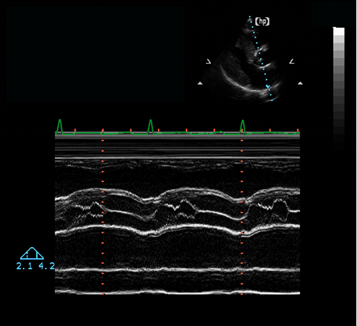 <p>This aortic valve M-mode is consistent with which of the following?</p><p></p><p>Bicuspid aortic valve</p><p>&nbsp;</p><p>Mid-systolic closure of the aortic valve</p><p>&nbsp;</p><p>Premature opening of the aortic valve</p><p>&nbsp;</p><p>Eccentric closure of the aortic valve</p>