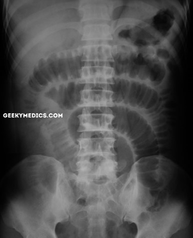 <p>Bowel Obstruction</p>