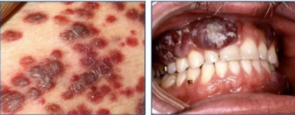 <p>cause of these lesions </p>