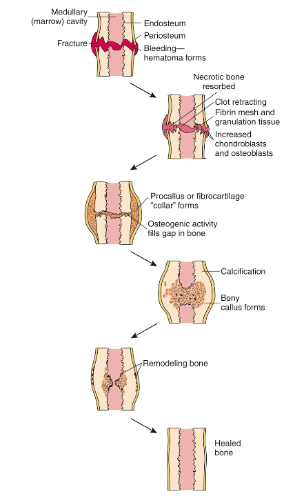 <ol><li><p>Hematoma formation</p></li><li><p>Fibrocartilage formation</p></li><li><p>Callus formation</p></li><li><p>Ossification</p></li><li><p>Consolidation/remodeling</p></li></ol>