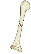 <ul><li><p>bone has broken and the skin is NOT broken—-its still closed </p></li><li><p>bone remains in its correct alignment</p></li></ul><p></p>