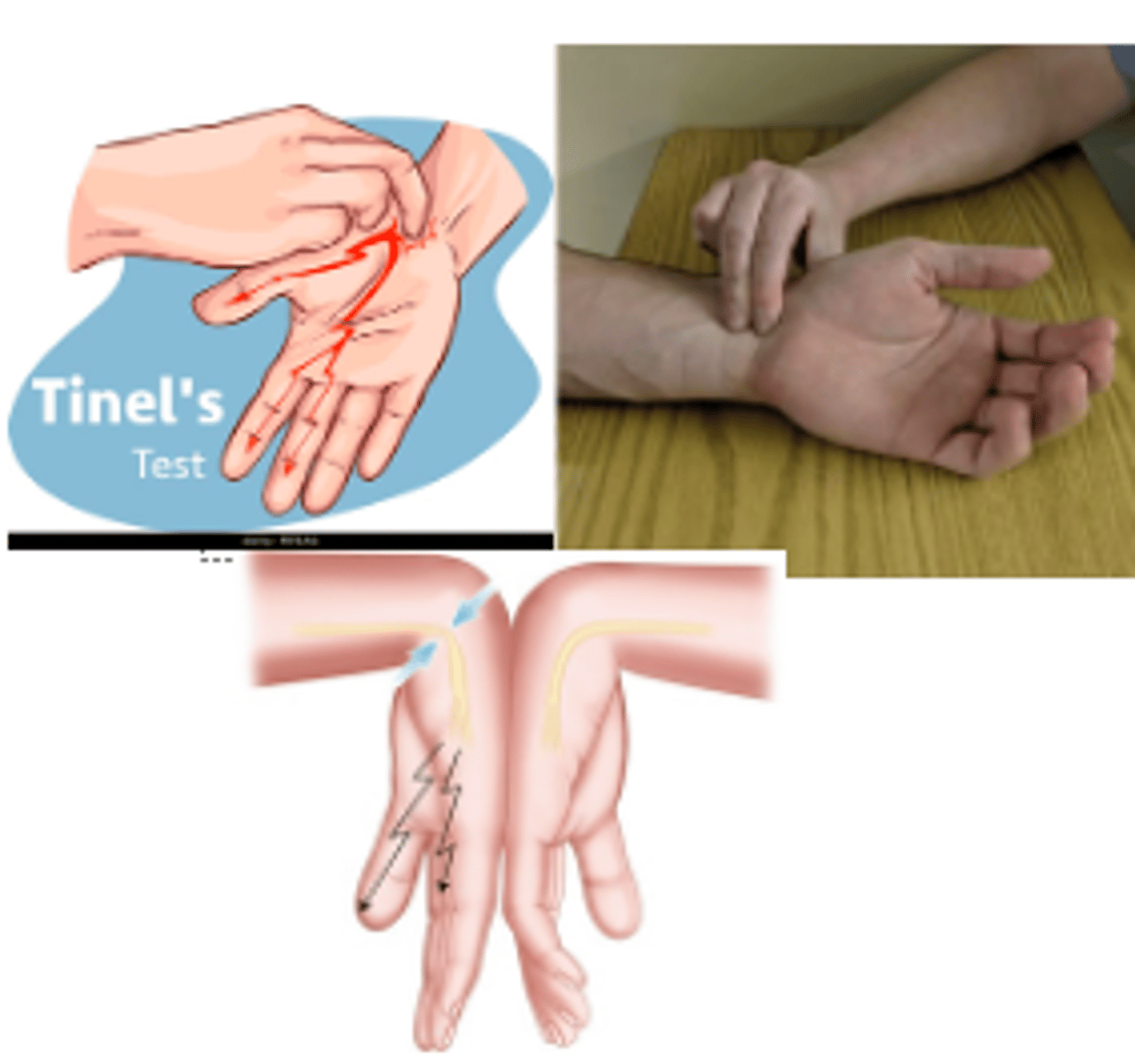<p>Phalen</p><p>Tinel</p><p>Pressure test</p>