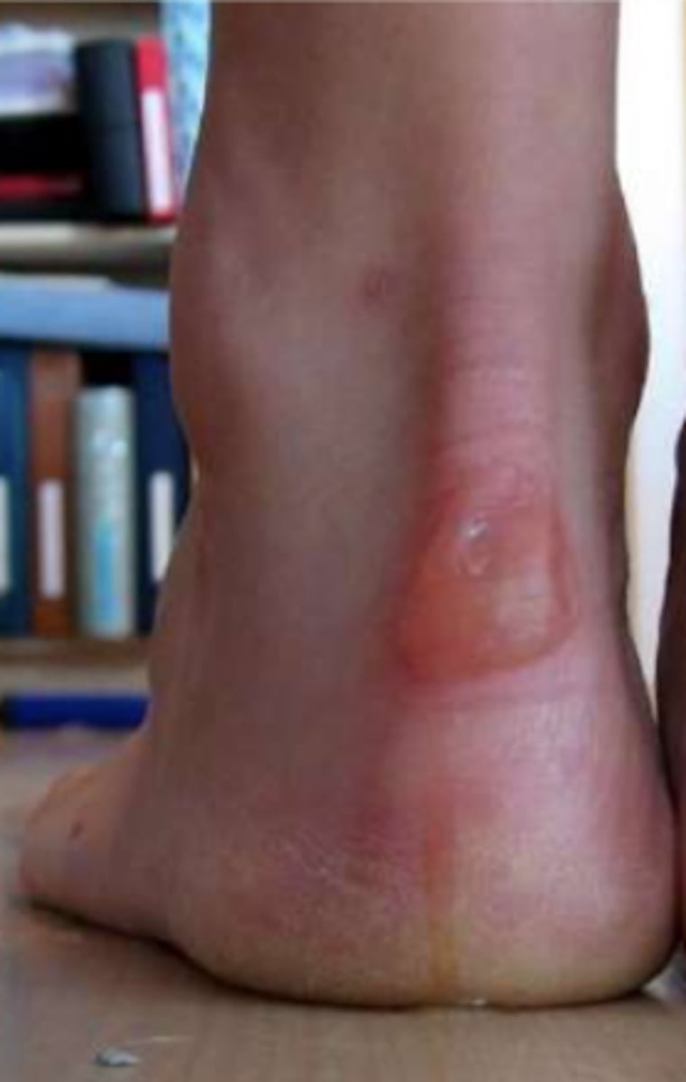 <p>¿lesión?</p><p>¿primaria o secundaria?</p>