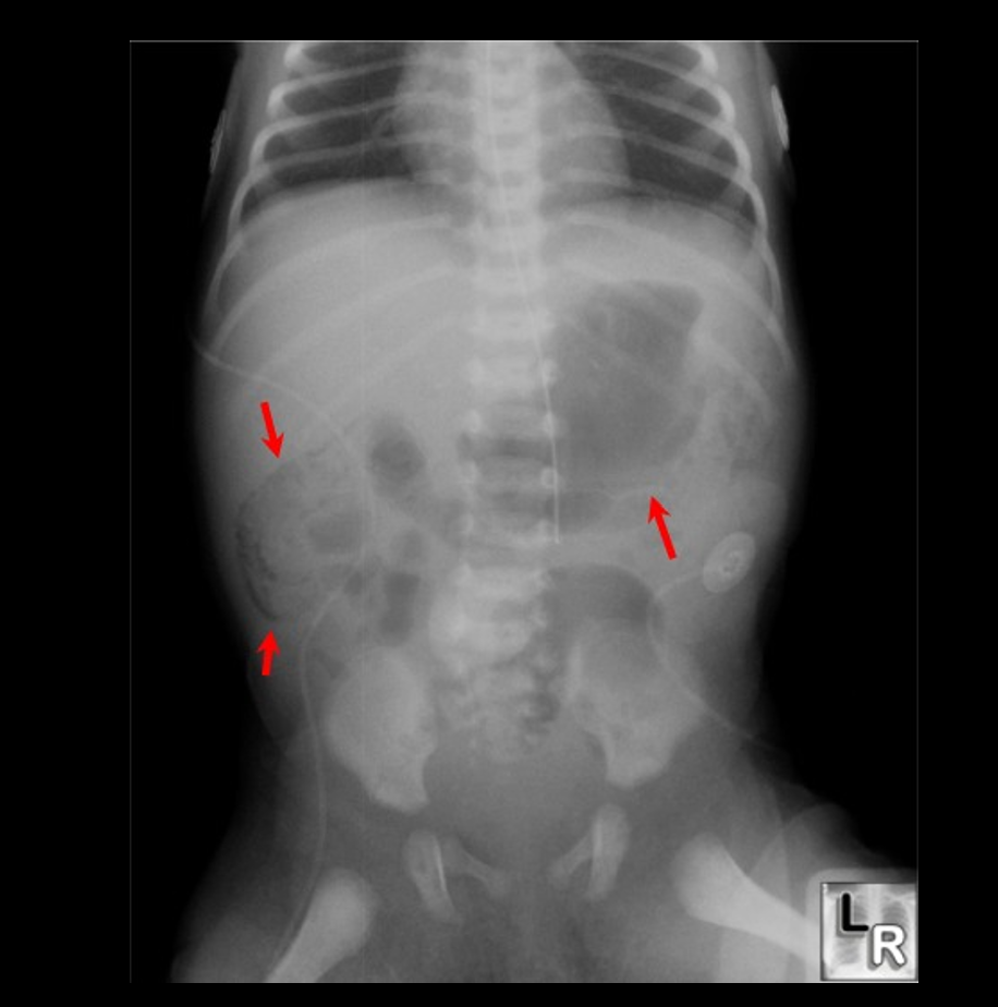 <p>Gas bubbles/cysts in abdomen</p><p>Caused by bacterial colonization (fermentation byproducts)</p>
