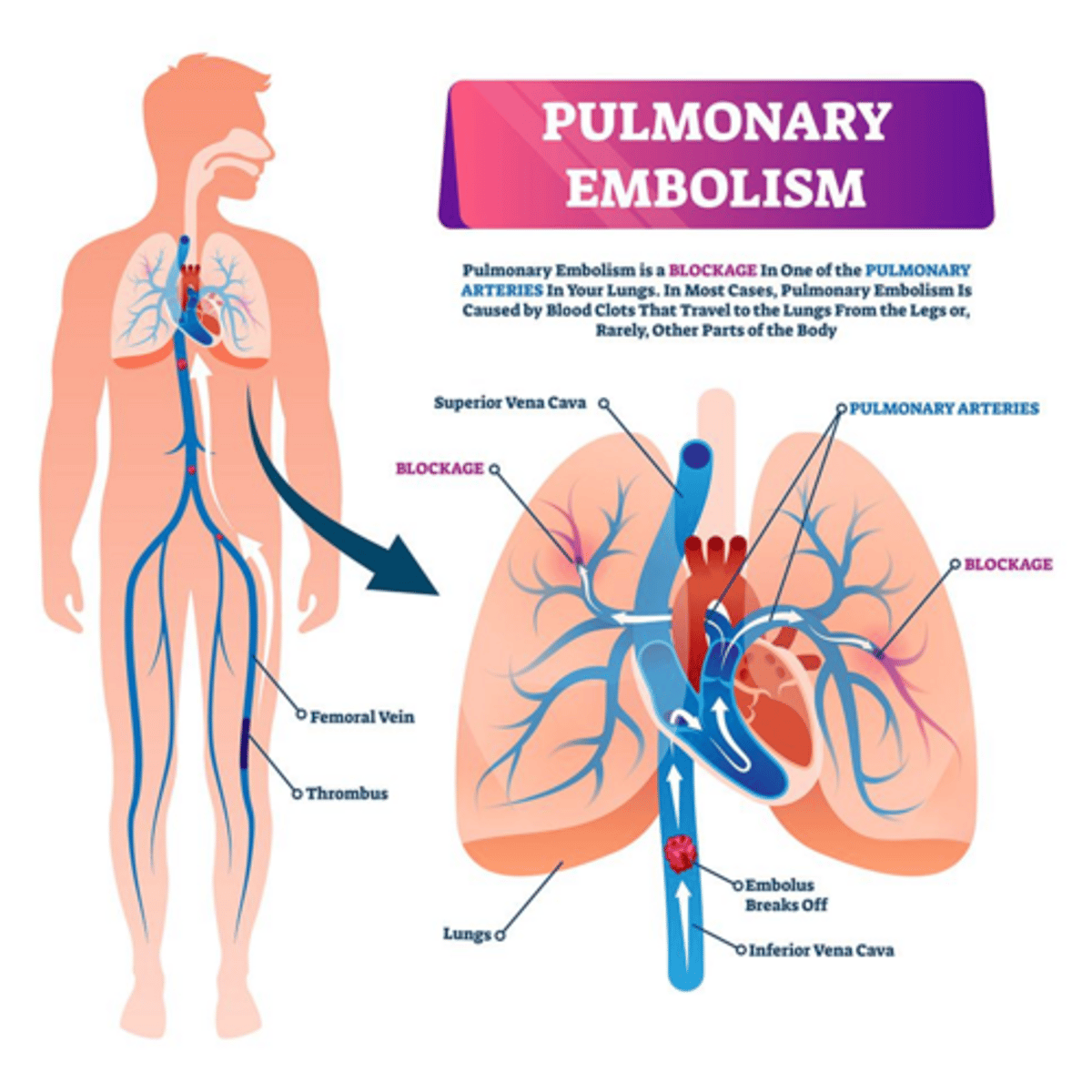 <p>CT pulmonary angiography (CTPA) and V/Q scan</p>