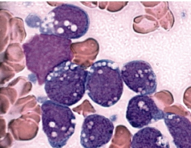 <p>FAB classification that refers to burkitt leukemia with vacuolations:</p>