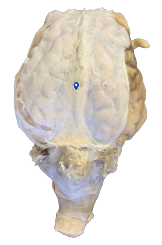 <p>What is the extension of the meninges that runs between the hemispheres of the cerebrum?</p>