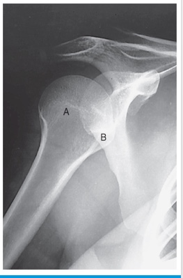 <p>position of humerus?</p>