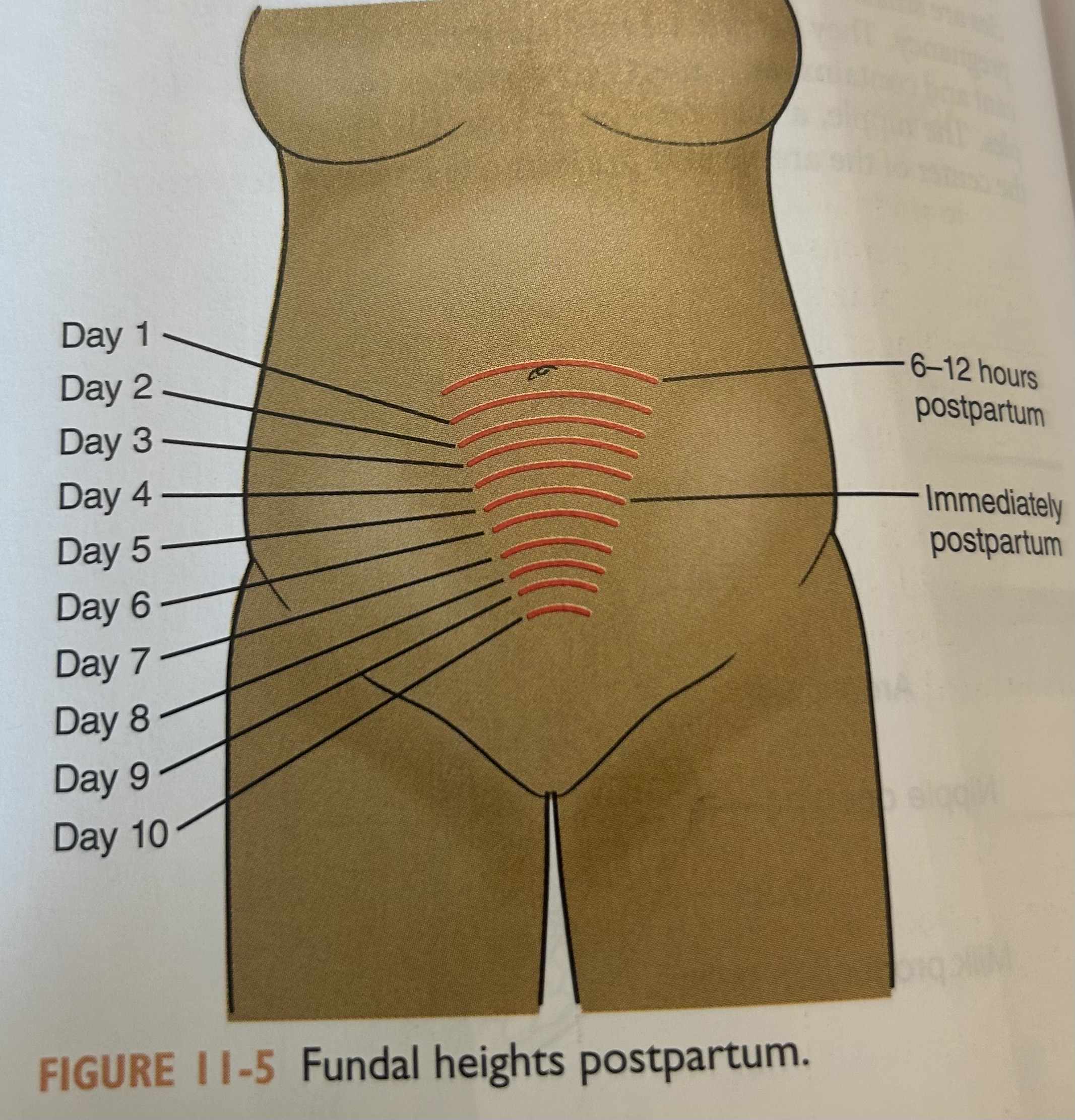 <p>Midline, midway between umbilicus and symphysis pubis </p>