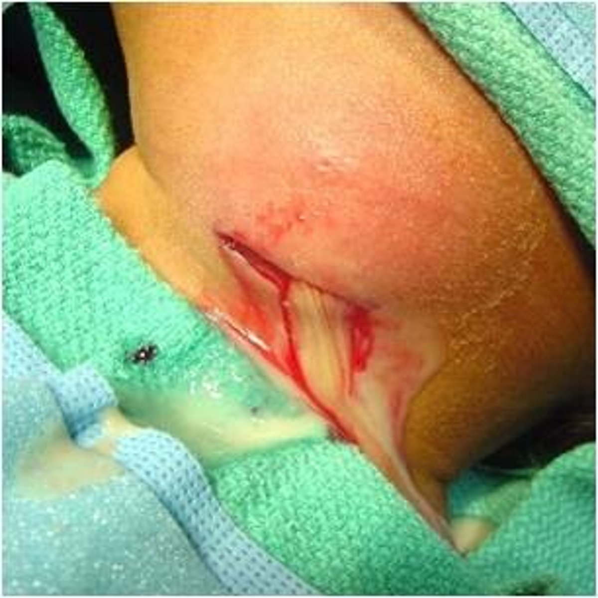 <p>Purulent</p><p>Purulent drainage contains dead phagocytes, bacteria, and tissue and is thick in consistency. It occurs when an infection is present.</p>