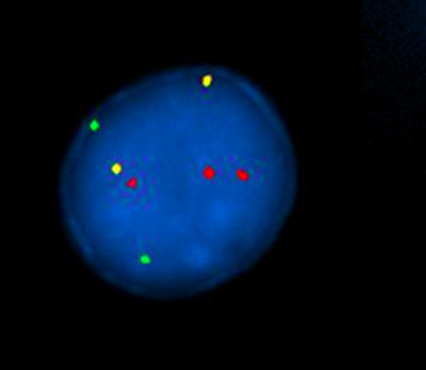 <p>The Amniocentesis and FISH result shows as following. What is the most likely possible karyotype?<br>Red: chromosome 21<br>Yellow: chromosome 14<br>Green: chromosome 12</p>