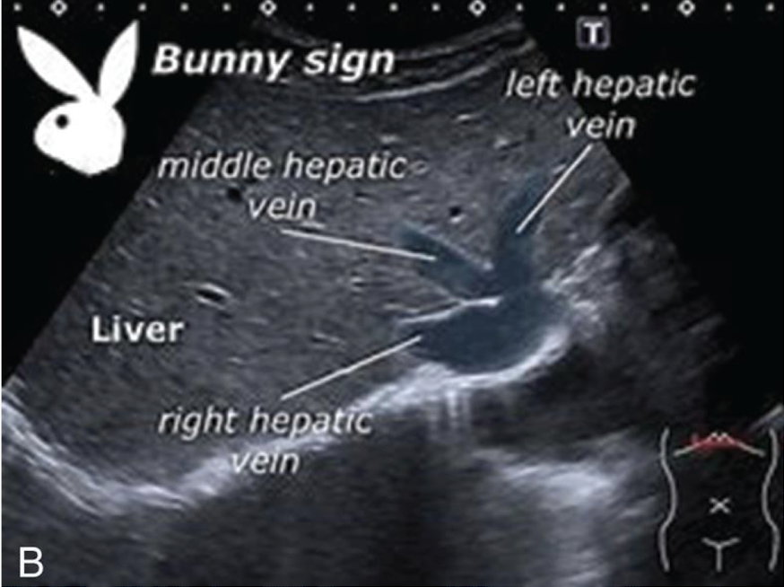 <p>LHV, MHV, and RHV</p>