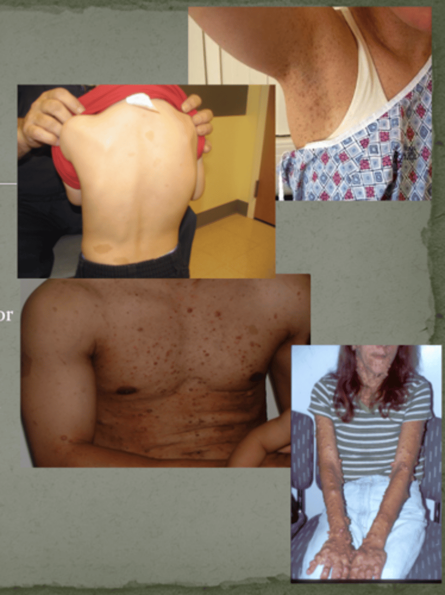 <p>Neurofibromatosis type 1</p>