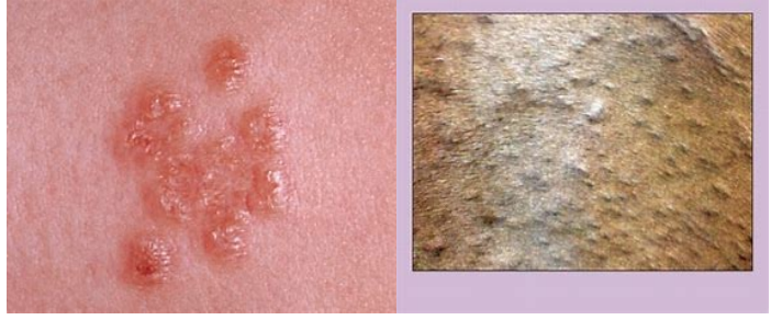 <p>are solid, circumscribed, elevations in the skin that are &lt;1 cm in diameter. They can be follicular (e.g., stap­hylococcal folliculitis) or nonfollicular (e.g., flea-bite hypersensitivity).</p>