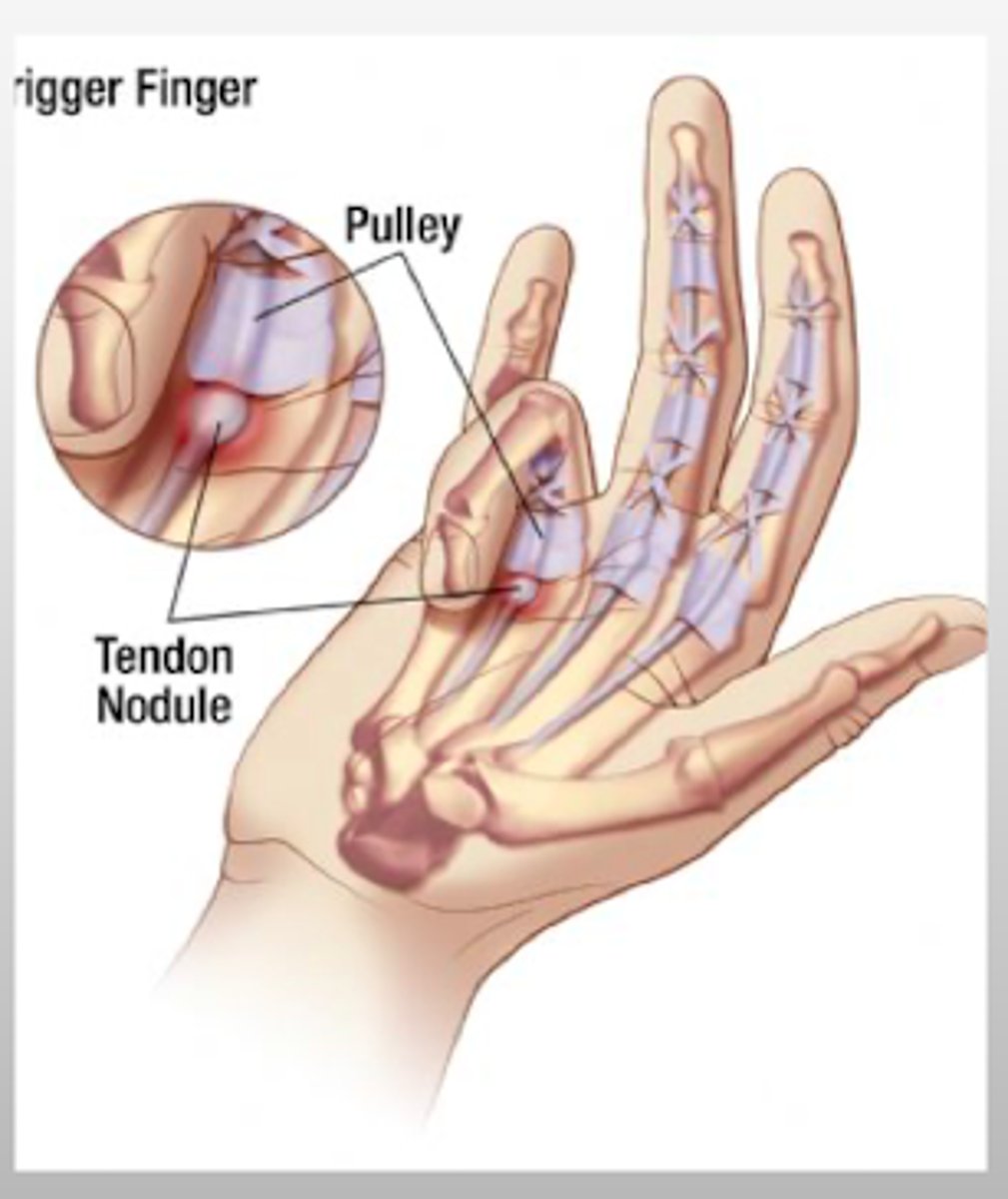 <p>painful snapping sensation or catch or lock during flexion</p>