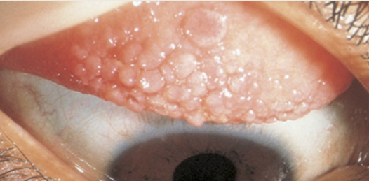 <p>Mechanical irritation:</p><ul><li><p>CL: protein build up on lens</p></li><li><p>Ocular prosthetic</p></li><li><p>Exposed suture- commonly seen with corneal transplant</p></li><li><p>Scleral buckle- retinal detachment repair</p></li><li><p>Filtering bleb from trabeculectomy: glaucoma surgery</p></li><li><p>Mucus fishing syndrome&nbsp;</p></li></ul><p></p>