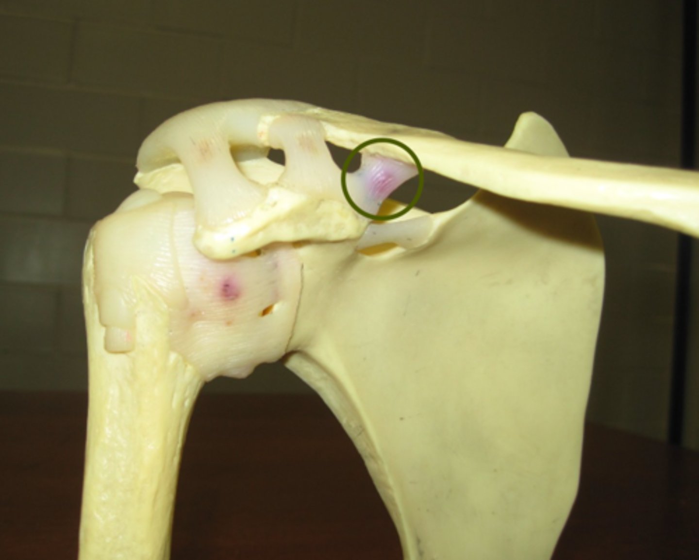 <p>medial part of coracoclavicular ligament - attaches to coracoid process of scapula and conoid tubercle of the clavicle</p>