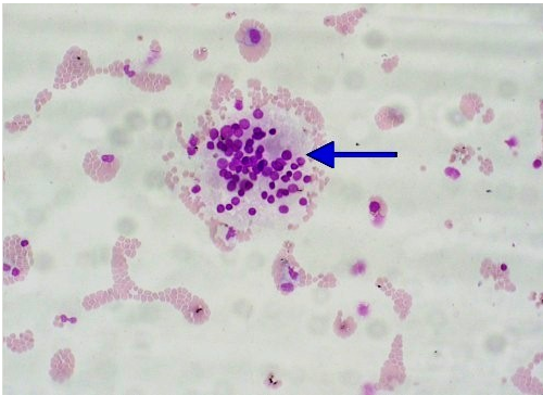 <p>What is the ID of this cellular clump found in CSF?</p><p>Cartilage Cell</p><p>Tumor Cell clump</p><p>Ependymal clump</p><p>Lymphoblast clump</p>
