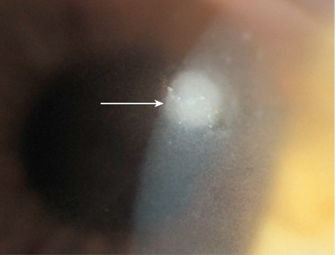 <ul><li><p>excavation of corneal tissue w/ epithelial defect</p></li><li><p>seen with deep infiltrate</p></li></ul><p></p>