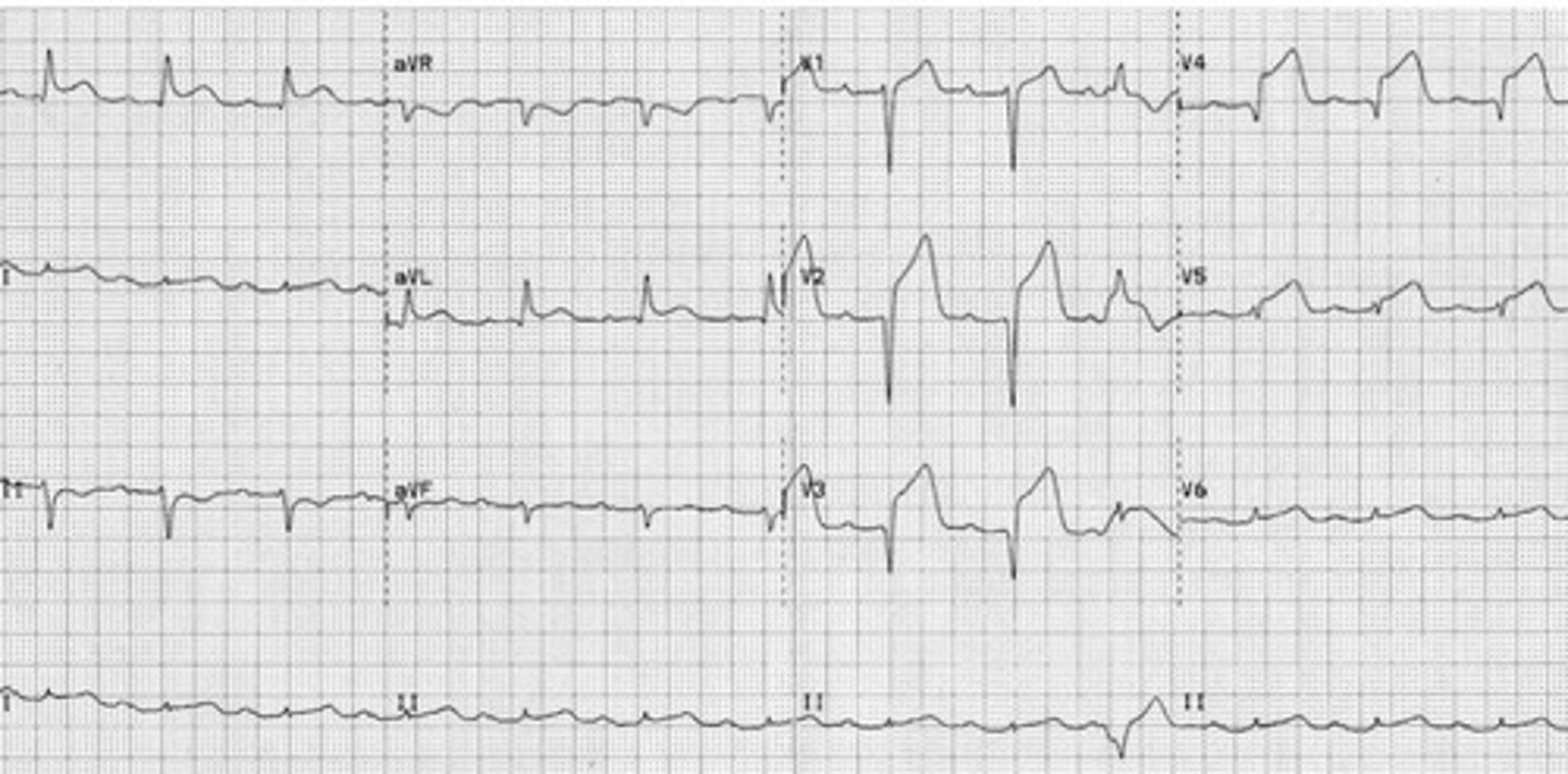 <p>Anterior STEMI</p>