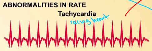 <ul><li><p>Tachycardia - racing heart</p><ul><li><p>If P, QRS, T is working a lot faster with no TP interval where ventricles will no longer fill, not enough oxygenated blood would pump through body</p></li></ul></li></ul><p></p>