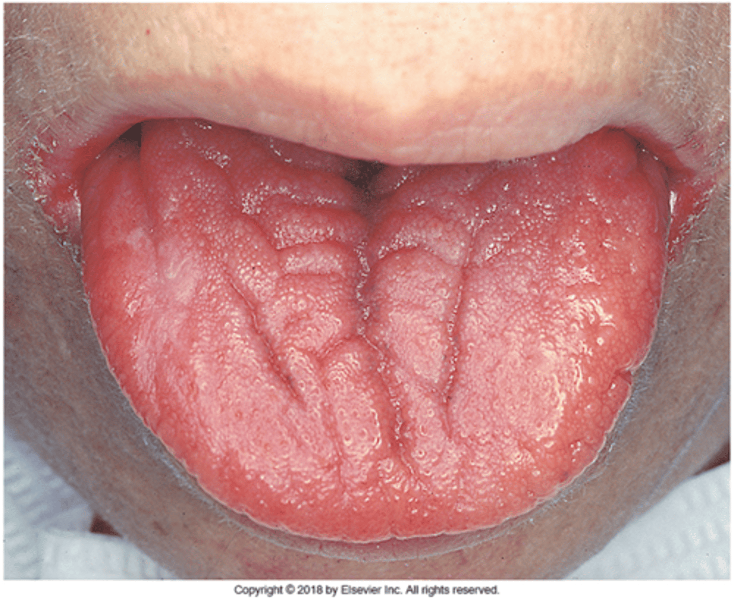 <p>-tongue is devoid of filiform papillae</p>