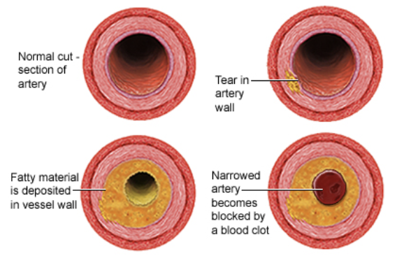 <ul><li><p>Diet rich in saturated fats contribute to the cardiovascular disease know at atherosclerosis</p><ul><li><p>Deposits called plaques develop within the walls of blood vessels, causing inward bulges that impede blood flow and reduce the resilience of the vessels</p></li></ul></li></ul><p></p>