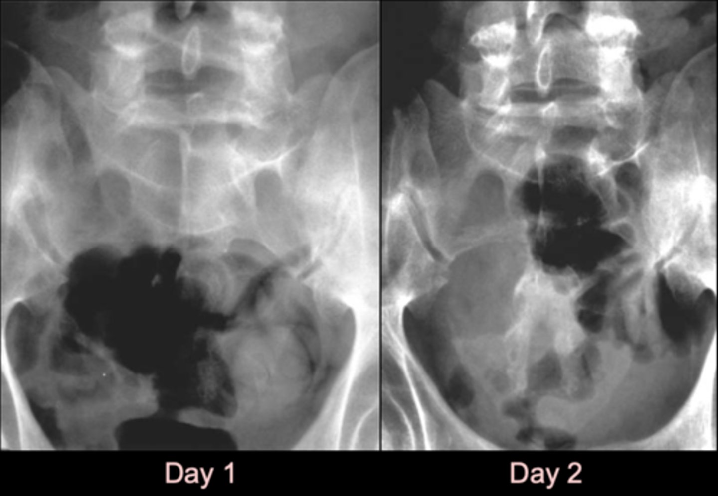 <p>Diagnosis?</p><p>- Missing inferior articular process</p>