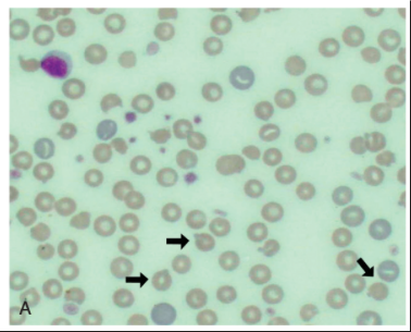 <ul><li><p><span>Aggregates of denatured, precipitated Hb molecules within erythrocytes that form as Hb with oxidative damage is metabolized</span></p><ul><li><p><span>Oxidation of the SH groups of Hb causes conformational changes in the globin chain that result in precipitation of the denatured globin</span></p></li></ul></li><li><p><span>Aggregates of denatured globin and metabolized metHb clump into Heinz bodies and continue to coalesce until visible, pale structures can be seen within the red blood cell cytoplasm</span></p></li></ul><p></p>