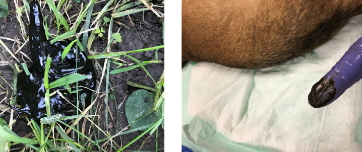 <p>dark, tarry oxidized blood in feces</p><p>dark black stool can also be seen with bismuth (pepto) and iron supplementation</p>