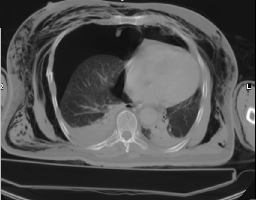 <p>subcutaneous emphysema</p>