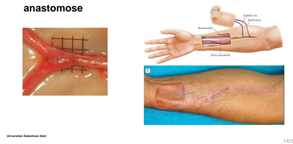 <p>Microvasculaire anastomose → conecteren bloedvaten<br>Donorsite morbiditeit → plek op arm kan ook sensibiliteit hebben!</p>