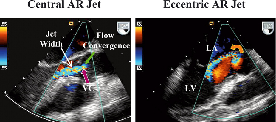 <p>measure of the effective regurgitant orifice area (narrowest area of actual flow) </p>