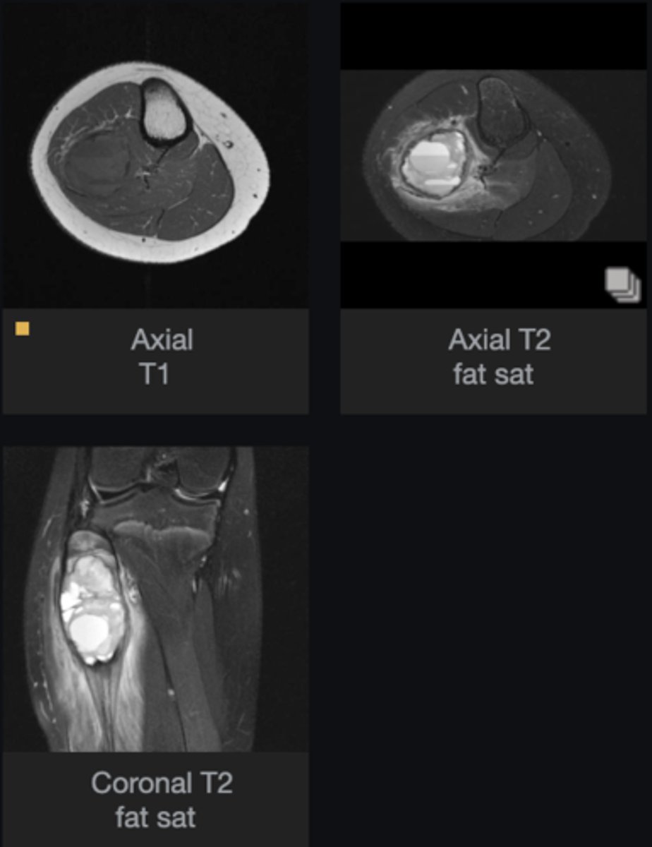 <p>- Are there any features that help you diagnose this lesion?</p><p>- What is the most likely diagnosis?</p>