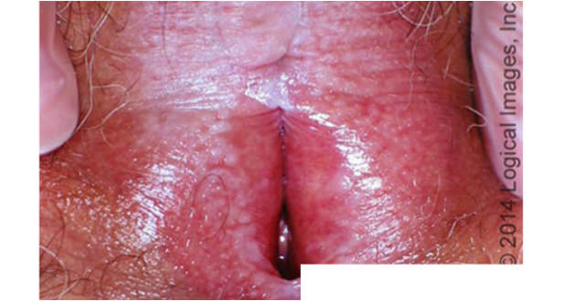 <p>violaceous papules on glans penis or vulva</p><p>vuvlo-vaginal-gingival syndrome involves epithelium of vulva, vestibule, vagina, and mouth</p><p>resistant to tx</p>