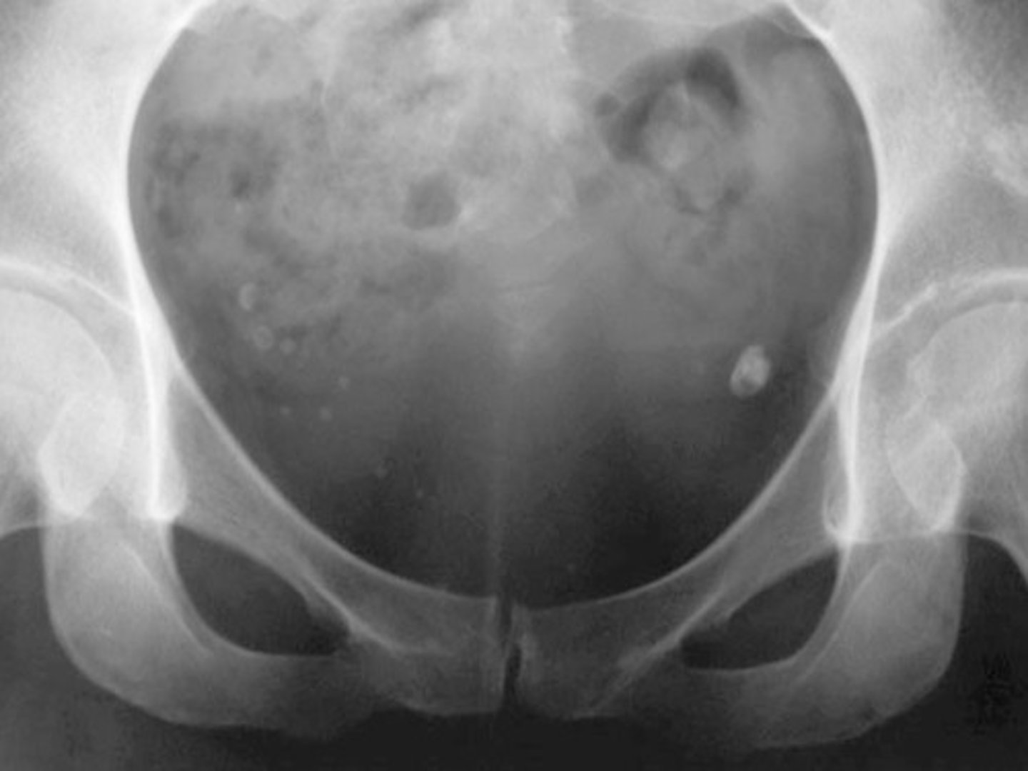 <p>Calcified venous thrombi</p><p>Perirectal veins (not midline)</p>