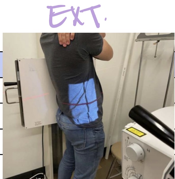 <p>SID: 40”</p><p>Air Gap: NO</p><p>Cassette Size: 14×17</p><p>Collimation: 10×17</p><p>Tube tilt: N/A</p><p>Measure through: largest dimension of abdomen</p><p>Central ray: iliac crest</p><p style="text-align: left">Breathing: suspend EXPIRATION</p>