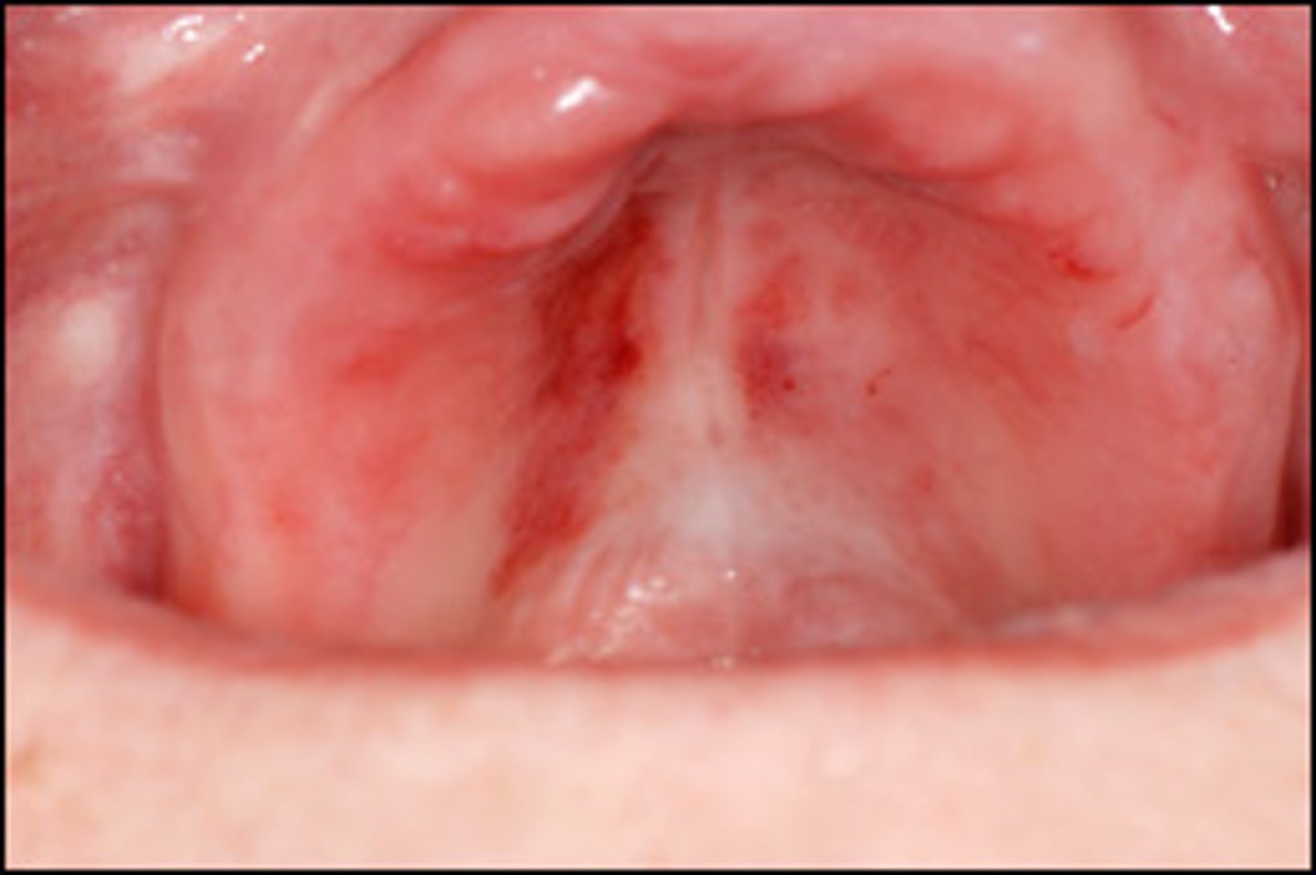 <p>A patient presents with a large blue-purple discoloration (>1 cm) on the mucosa resembling a bruise.</p><p>What is the most likely diagnosis?</p>