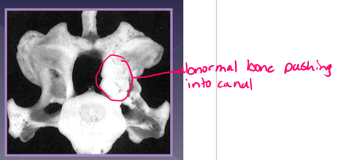 <ul><li><p><strong>young, giant breed, 9 ½ months old </strong></p><ul><li><p><strong>Great Dane* </strong></p></li></ul></li><li><p>ligamentum flavum hypertrophy </p></li><li><p><strong>vertebral canal stenosis due to: </strong></p><ul><li><p>proliferation of the vertebral arch </p></li><li><p>articular process proliferation </p></li><li><p>pedicle proliferation </p></li></ul></li></ul><p></p>