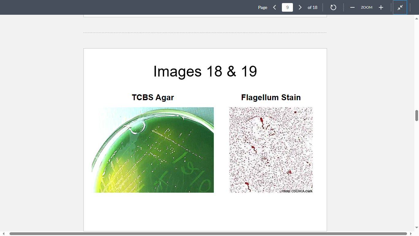 <p>An outbreak of infectious diarrhea was reported from West Bengal, India, during the most recent monsoon season. Since June, a steady stream of deaths has been reported from Kolkata. More than a hundred people developed large volume watery diarrhea with “rice water” and died within hours. The most likely etiologic agent is depicted in Images 18&19. Which of the following factors may have contributed most to the pathogenesis of this disease?</p>